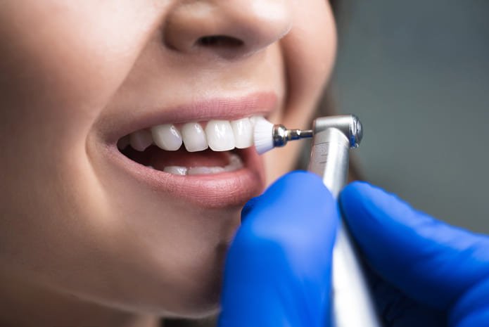 como-cuidar-las-carillas-dentales