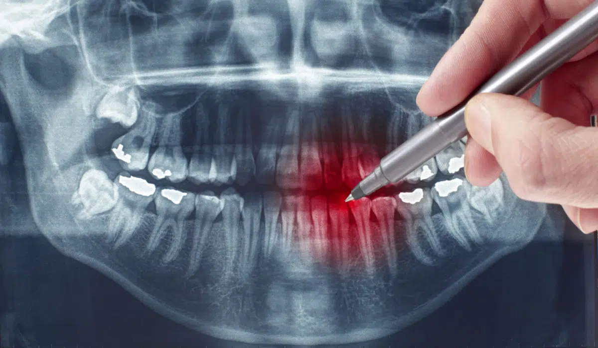 exodoncia-clinica-dental-julian-saiz-02
