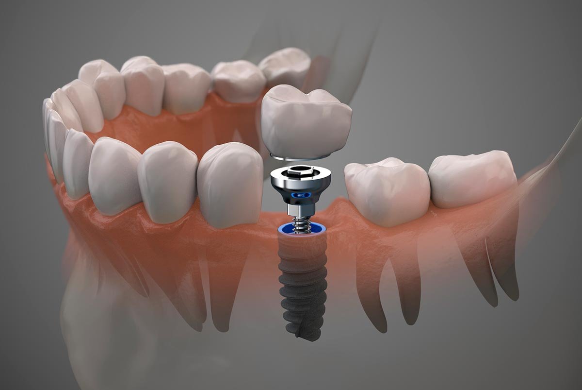 implantes-dentales-duelen