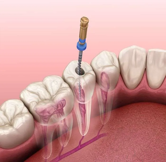 ventajas-endodoncia